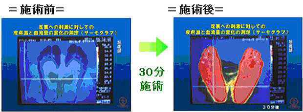 足裏サーモグラフの変化